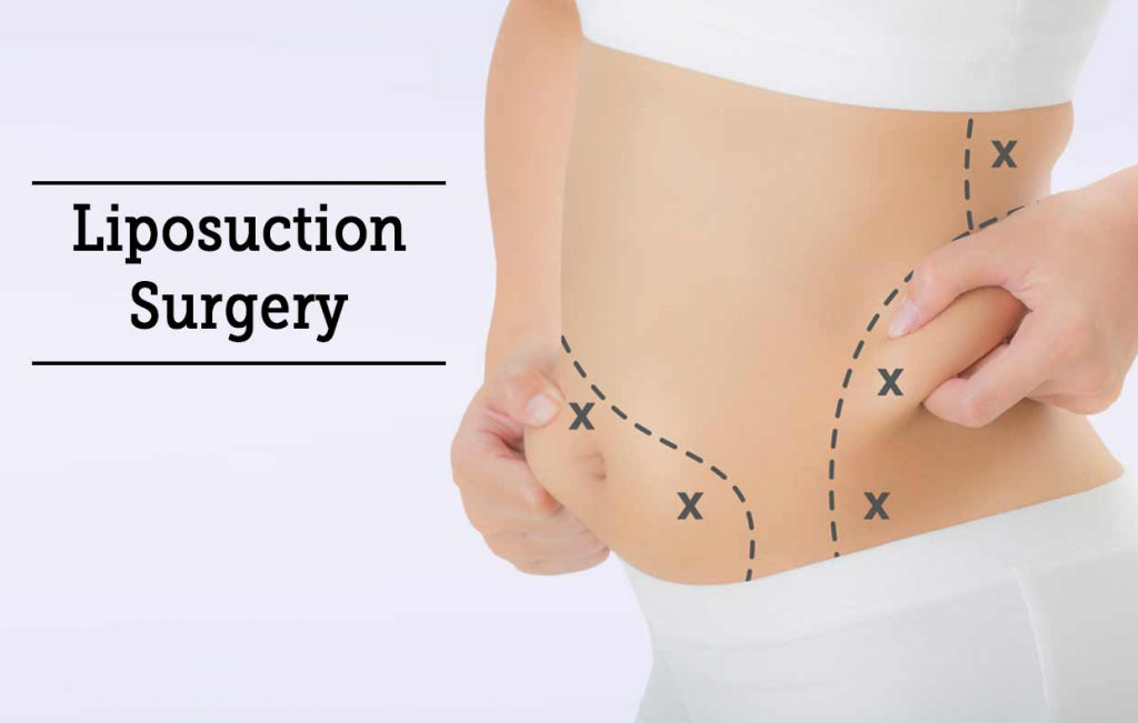 Questions to Ask Your Surgeon Before a Liposuction Surgery